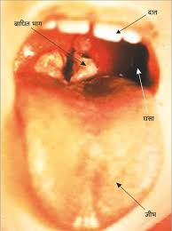Diphtheria