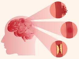 Stroke Ke Lakshan